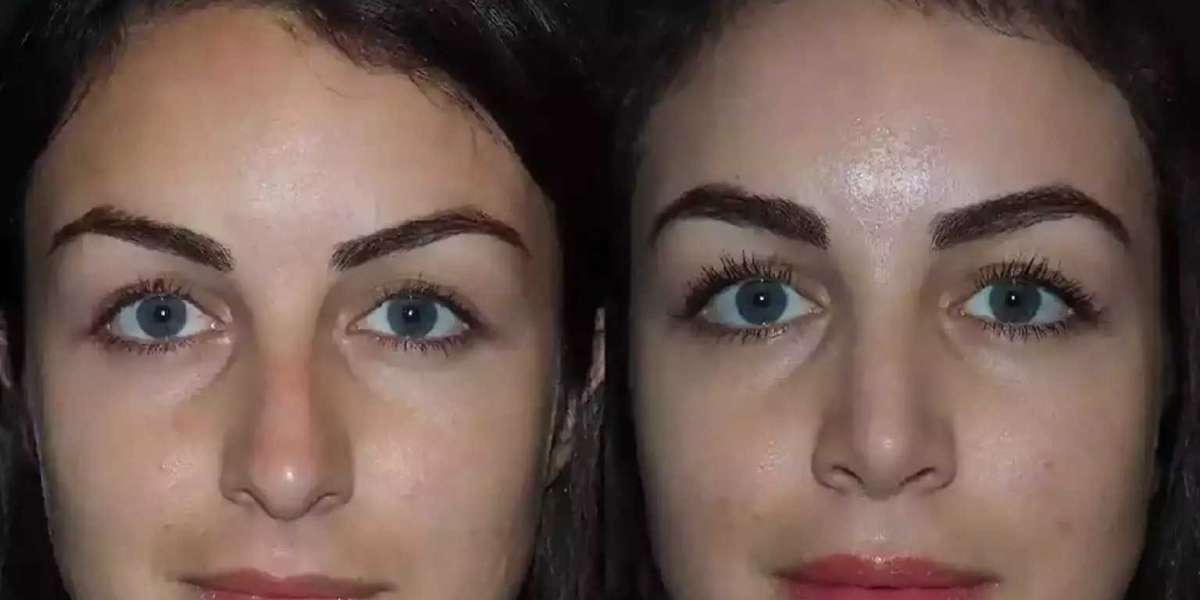 How Is Septoplasty in Dubai Tailored to Different Nasal Conditions?