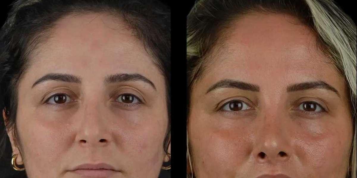 Cheek Fillers for Youthful Appearance by Best Plastic Surgeons in Dubai