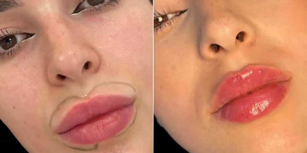 How to Prepare for a Fillers Consultation with a Best Plastic Surgeons in dubai