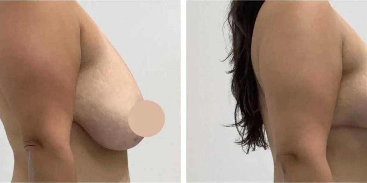 Best Doctors in Dubai for Breast Lift and Beautifully Elevated Breast Contours