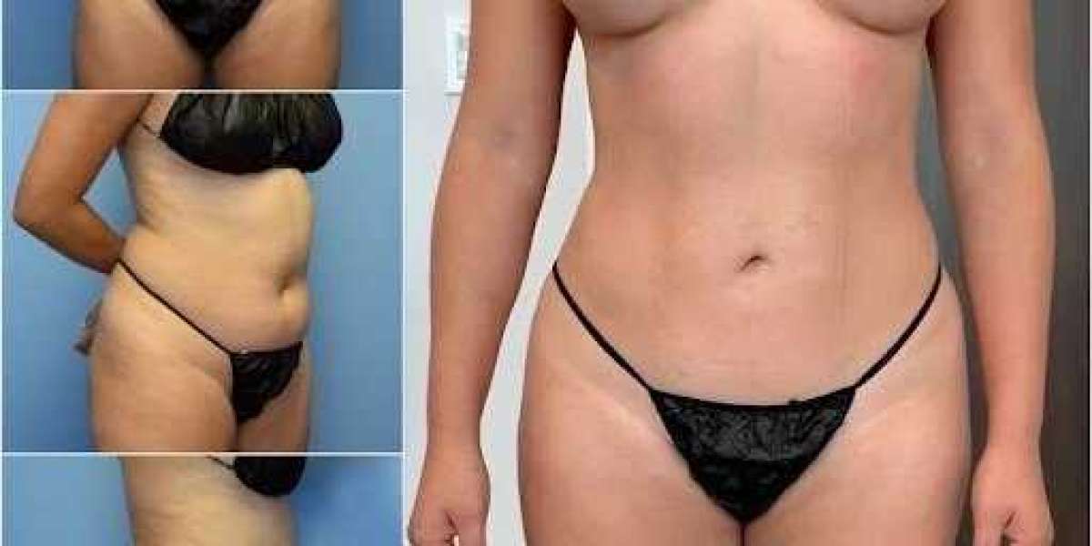 Refine Your Silhouette with Professional Body Contouring in Dubai
