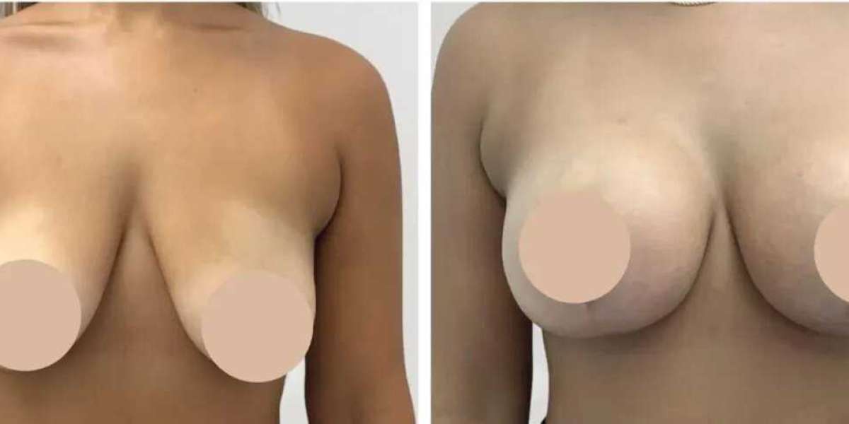 Best Doctors in Dubai for Breast Reduction and Modern Cosmetic Solutions