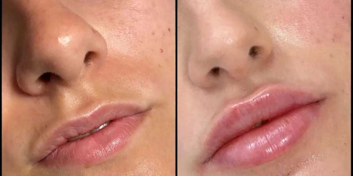 Fillers Treatments in Dubai for Defined Cheeks and Jawline