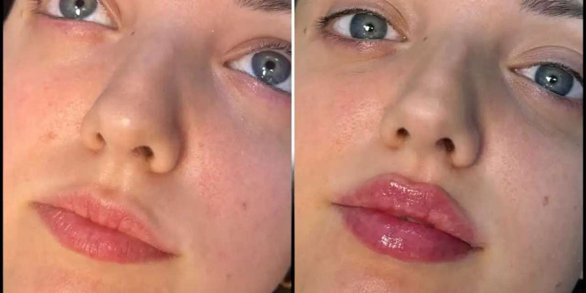 Best Plastic Surgeons in dubai for Subtle Dermal Fillers