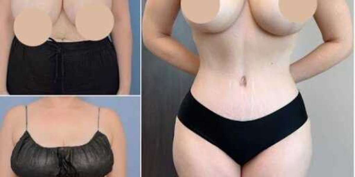 Tummy Tuck in Dubai: Understand Scarring, Healing, and Long-Term Care
