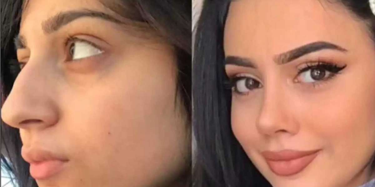 Can Rhinoplasty in Dubai Help Refine a Wide Nasal Bridge?