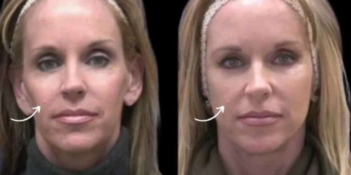 Best Aesthetic Clinics in Dubai: Sculptra and Skin Resurfacing Decisions